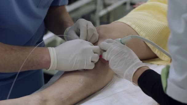 Cirugía en la pierna de los pacientes — Vídeo de stock