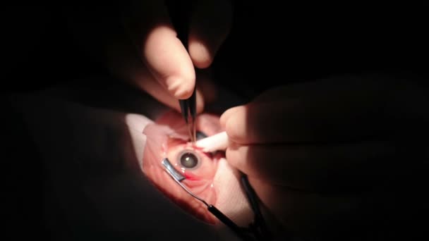 Руки врача с инструментами, делающими глазную операцию — стоковое видео
