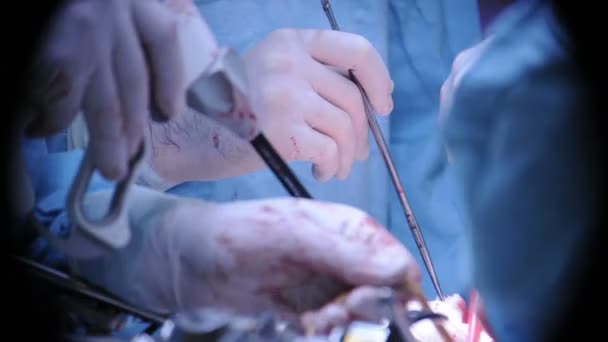 Médecins des mains faisant une chirurgie — Video