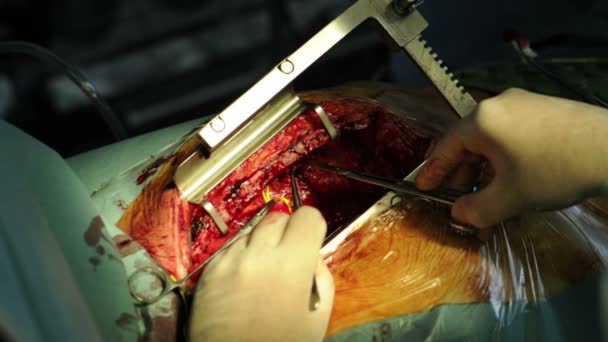 The surgeon makes an operation on the heart — Stock Video