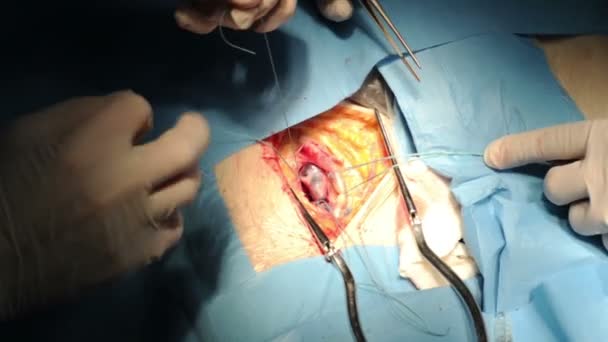 Доктор и его ассистент делают операцию на ноге — стоковое видео