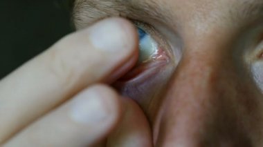 Mavi gözde kontakt lensler kaldırır