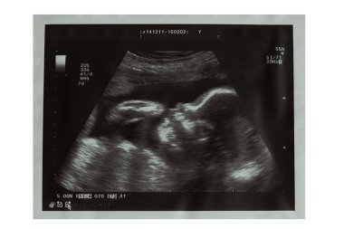 Bebek ultrason resmini