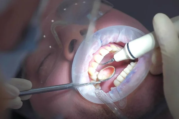 Пациент на ультразвуковой процедуры чистки зубов в стоматологии стоматологом. — стоковое фото