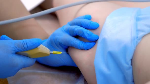 Косметолог делает инъекции углекислого газа на бедре пациента на карбоксиотерапии. — стоковое видео