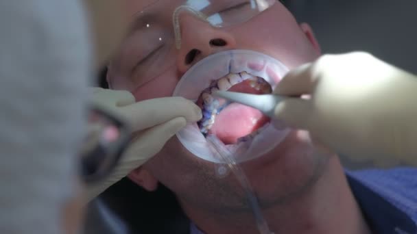 Dentist is watering washes off blue gel from mans teeth, closeup view. — Stock Video