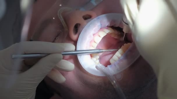 Paciente hombre en procedimiento de limpieza de dientes ultrasónicos en odontología por dentista. — Vídeo de stock