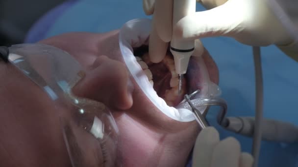 Pacient muž na ultrazvukové čištění zubů postup v zubním lékařství zubním lékařem. — Stock video