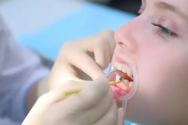 Orthodontiste couvrant gel spécial sur les dents de femme en dentisterie à l'aide d'une brosse. — Photo