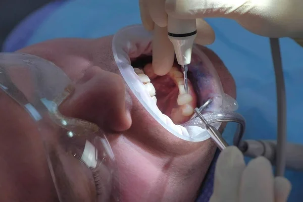 Пацієнт на ультразвуковій процедурі чищення зубів у стоматології стоматологом . — стокове фото
