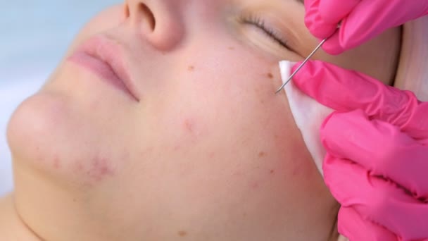 Médico esteticista pinchando acné en la cara de la mujer usando aguja y limpiando almohadillas de algodón. — Vídeo de stock