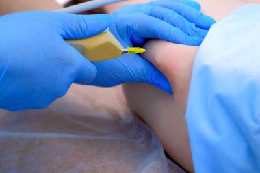 Kozmetik uzmanı karbondioksit enjekte ediyor..