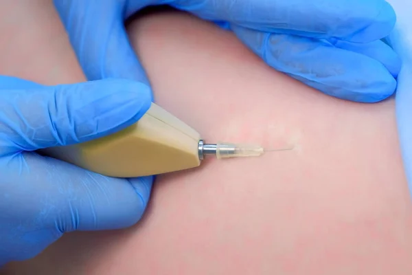 Doctor is making injection of carbon dioxide on patients hip on carboxytherapy. — Stock Photo, Image