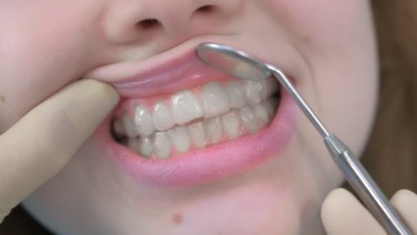 Ortodoncista mirando con espejo dental en frenos transparentes en los dientes de las niñas. — Vídeo de stock