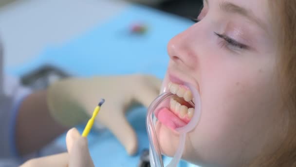 Orthodontist bedekken speciale gel op vrouwelijke tanden in de tandheelkunde met behulp van borstel. — Stockvideo