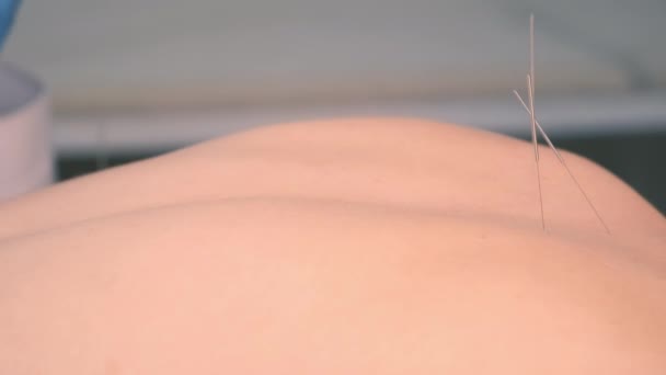 Mãos de médico acupunturista insere agulhas de acupuntura para as mulheres de volta. — Vídeo de Stock