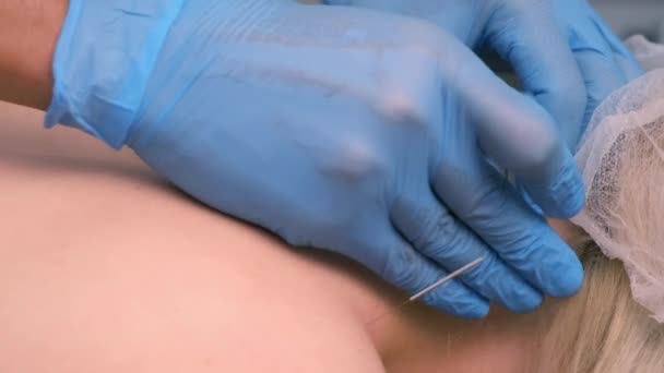 Hands of doctor acupuncturist inserts acupuncture needles to womans neck. — Stock Video