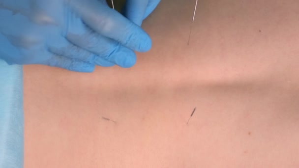 医生针灸师的手将针头插入妇女背部. — 图库视频影像