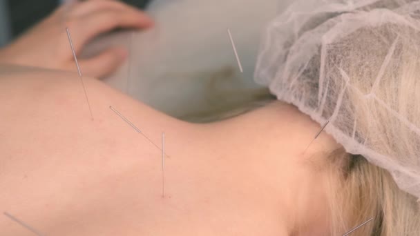 Tratamiento de acupuntura con agujas insertadas en la espalda y el cuello de las mujeres, primer plano. — Vídeos de Stock