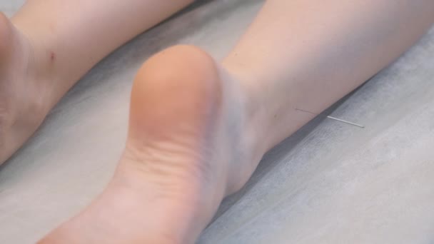 Zabieg akupunktury z igłami wbitymi w kobiecą nogę, widok z bliska. — Wideo stockowe