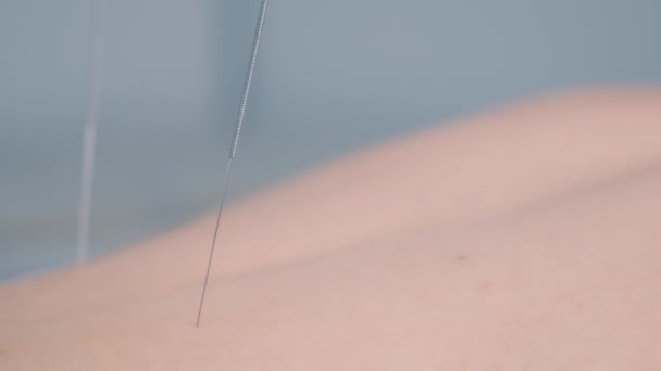 Mulher em tratamento de acupuntura com agulhas inseridas nas costas, close-up. — Vídeo de Stock