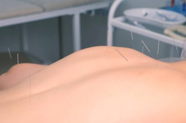 Kadınlara iğneler batırılmış akupunktur tedavisi, yakın görüş.