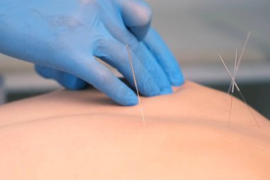 Doktor akupunkturcunun elleri kadınlara akupunktur iğnesi batırıyor..