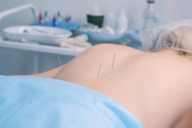 Kadınlara iğneler batırılmış akupunktur tedavisi, yakın görüş.