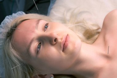 Kadınların yüzüne ve boynuna iğneler batırılmış akupunktur tedavisi, yakın plan..