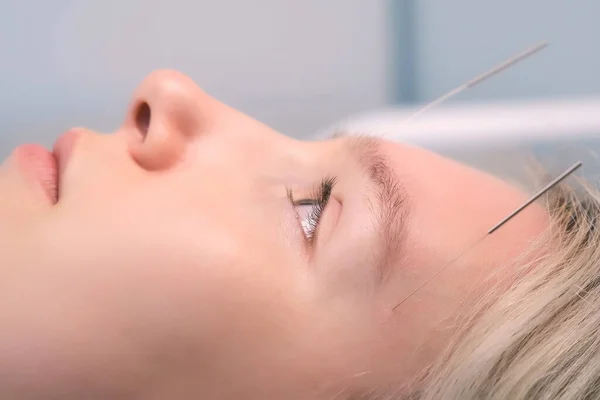 Acupuncture treatment with needles inserted to womans face, closeup side view