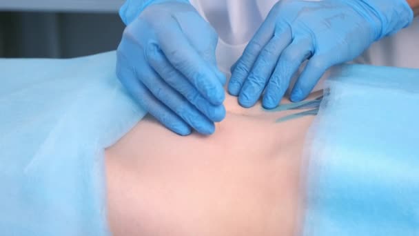 Homme médecin acupuncteur dans des gants insère aiguille d'acupuncture à l'abdomen de la femme. — Video