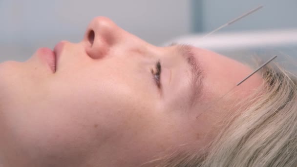 Tratamento de acupuntura com agulhas inseridas na face da mulher, vista lateral close-up — Vídeo de Stock