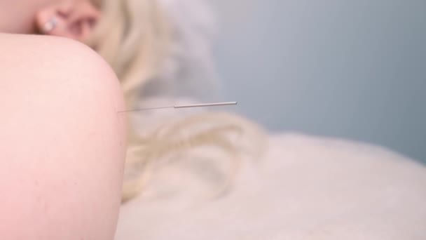 Mujer en tratamiento de acupuntura con aguja insertada en el hombro, primer plano. — Vídeos de Stock