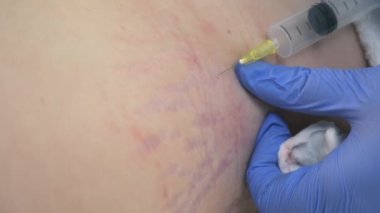 Doktor ozon terapisinde kadın vücuduna ozon gazı enjekte ediyor..