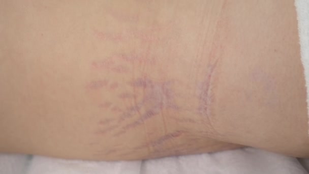 Part of womans body after childbirth and pregnancy, skin with heavy stretches. — Stock Footage Part of womans body after childbirth and pregnancy, skin with heavy stretches. Video Clip