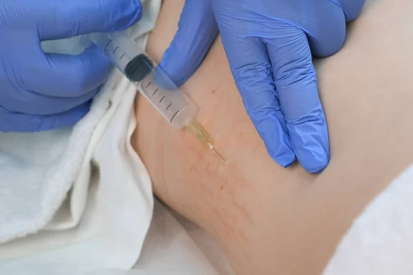 Врач делает инъекции озонового газа в тело женщины на стороне на озонотерапии. — стоковое фото
