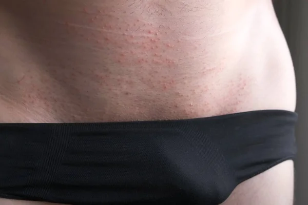 Rash pada kulit seorang pria di daerah selangkangan, konsep penyakit kelamin. — Stok Foto