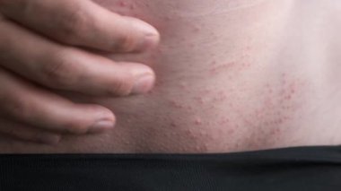 Adam karnındaki küçük lekeleri elle kaşıyor, yakın çekim görüntüsü..