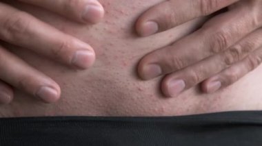 Adam karnındaki küçük lekeleri elleriyle kaşındırıyor. Yakın çekim görüntüsü..