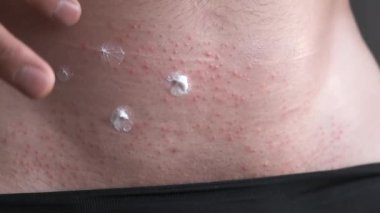 Adam kaşındıran cilt tahrişine kırmızı noktalarla merhem sürüyor..