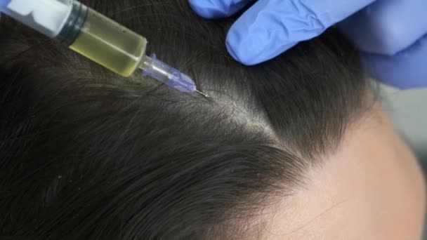 Врач-трихолог делает инъекции женской коже на голове для роста волос. — стоковое видео