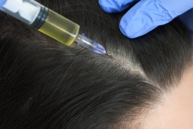 Doktor trikoloğu saç büyümesi için kadın derisine iğne yapıyor..
