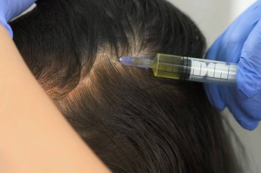 Doktor trikoloğu saç büyümesi için kadın derisine iğne yapıyor..