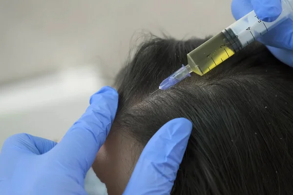 Arzt Trichologe macht Injektionen in Frau Haut Kopf für Haarwachstum. — Stockfoto