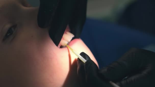 Dentista fazendo fluoretação de dentes de menino criança após a limpeza para proteção. — Vídeo de Stock