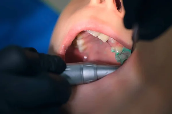 Dentista higienista haciendo limpieza higiénica oral en odontología para niño adolescente. — Foto de Stock