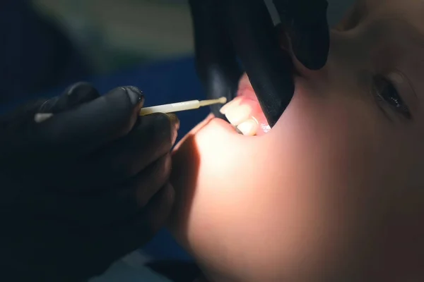 Dentista haciendo fluorización de los dientes de niño después de la limpieza para la protección. — Foto de Stock