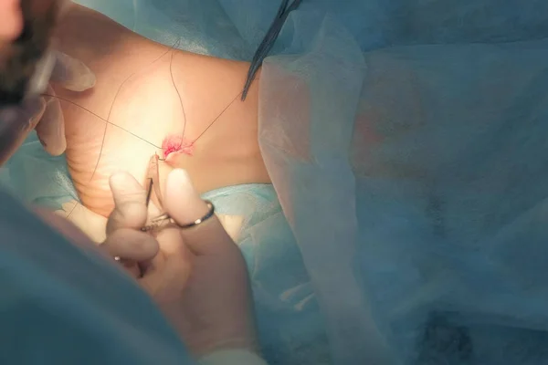 Хірург шиє щиколотки на нозі під час хірургічного втручання самопоглинаючими нитками . — стокове фото