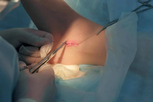 Хірург вишиває щиколотку після операції і зв'язує вузол самопоглинаючими нитками . — стокове фото