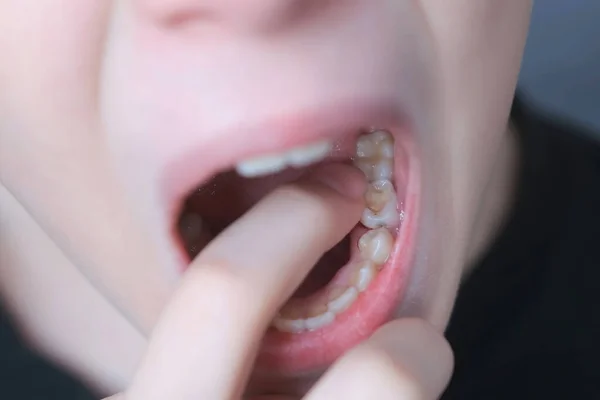 Молочный зуб во рту десятилетнего мальчика он раскачивает его пальцем, крупным планом. — стоковое фото